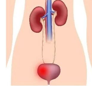 Reasons for the development of cystitis in women